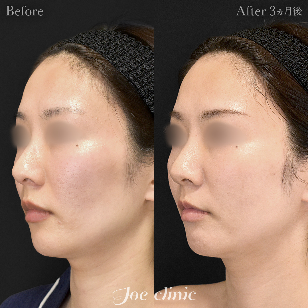 【30代女性・他院修正】顔の脂肪注入（こめかみ・頬）｜3ヵ月後