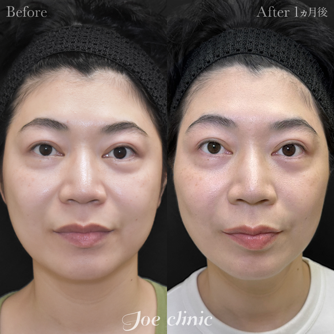 【30代女性】糸リフト（4Dデュアルクレオパトラリフト）＋ヒアルロン酸注入（ほうれい線）｜1ヵ月後