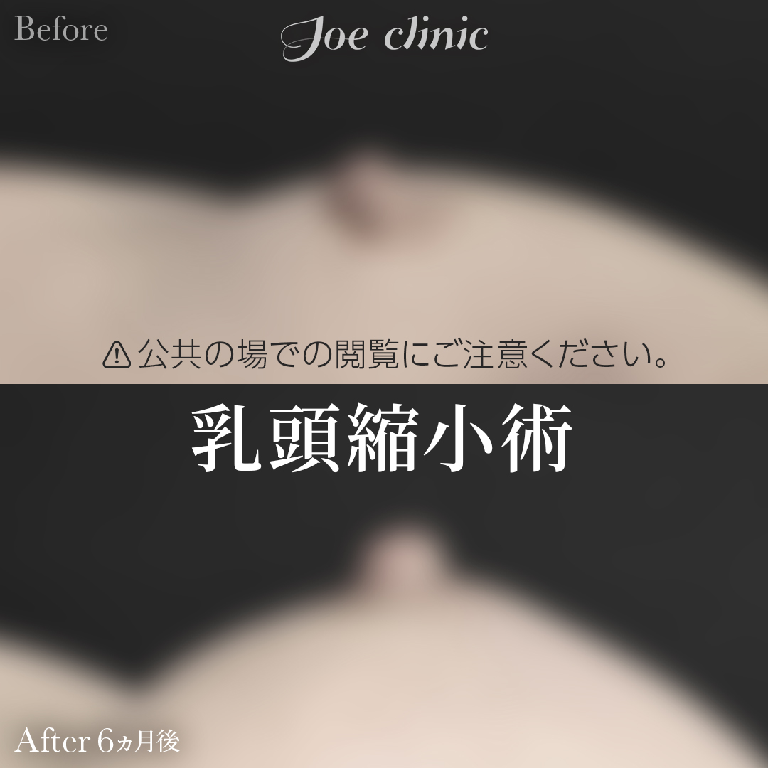 【50代女性】乳頭縮小術｜6ヵ月後