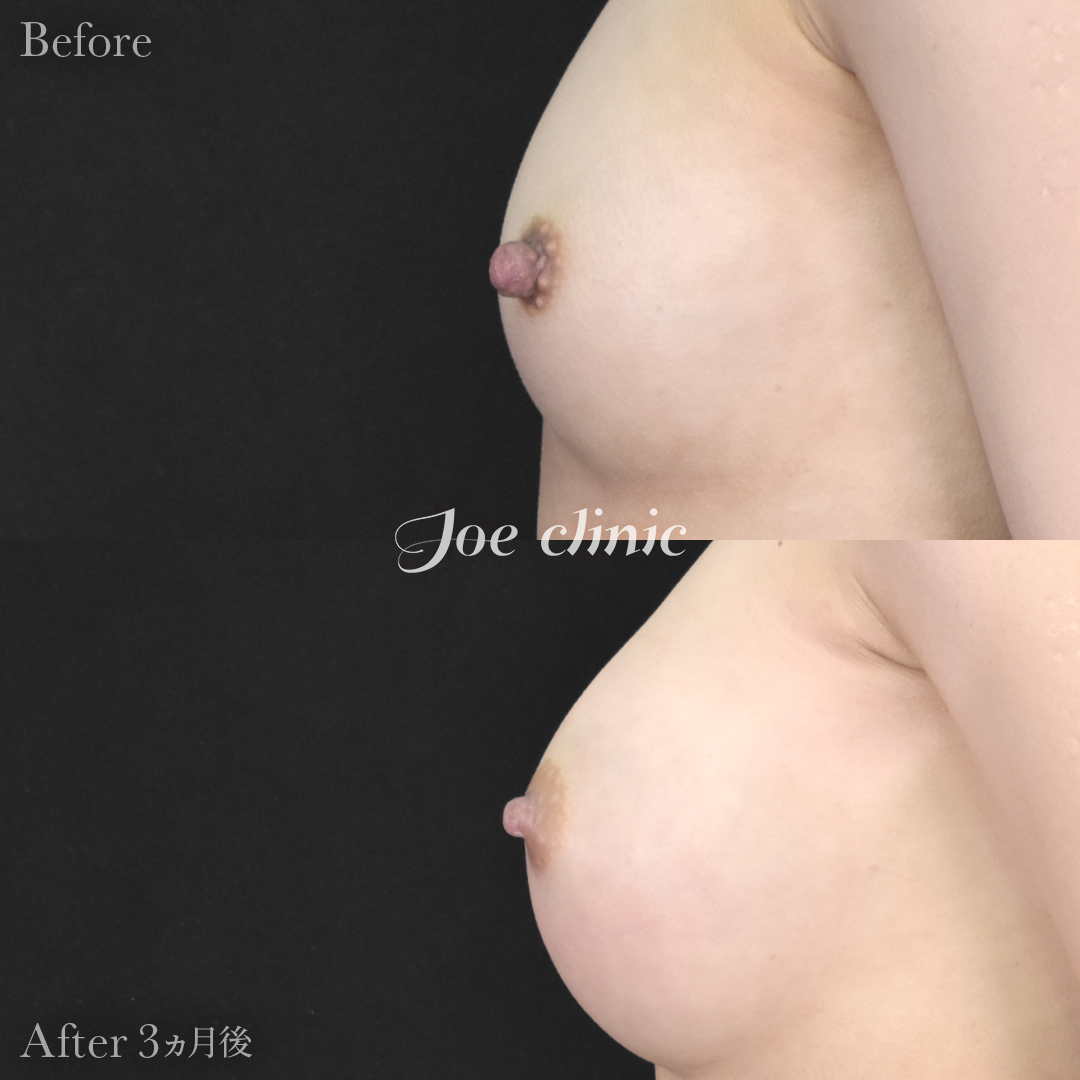 【30代女性】乳頭縮小術｜3ヵ月後
