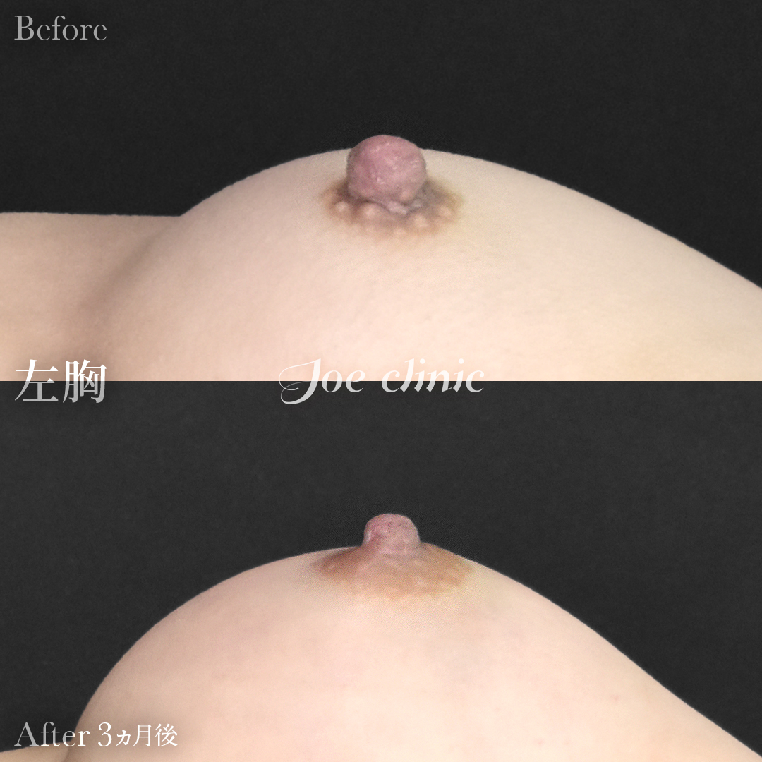 【30代女性】乳頭縮小術｜3ヵ月後