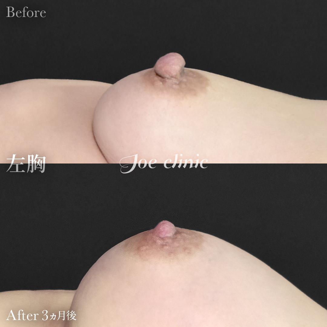 【40代女性】乳頭縮小術｜3ヵ月後