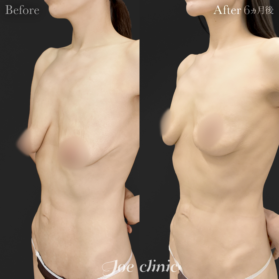 【30代女性】乳房吊り上げ術＋脂肪幹細胞注入豊胸（100cc×左右）｜6ヵ月後
