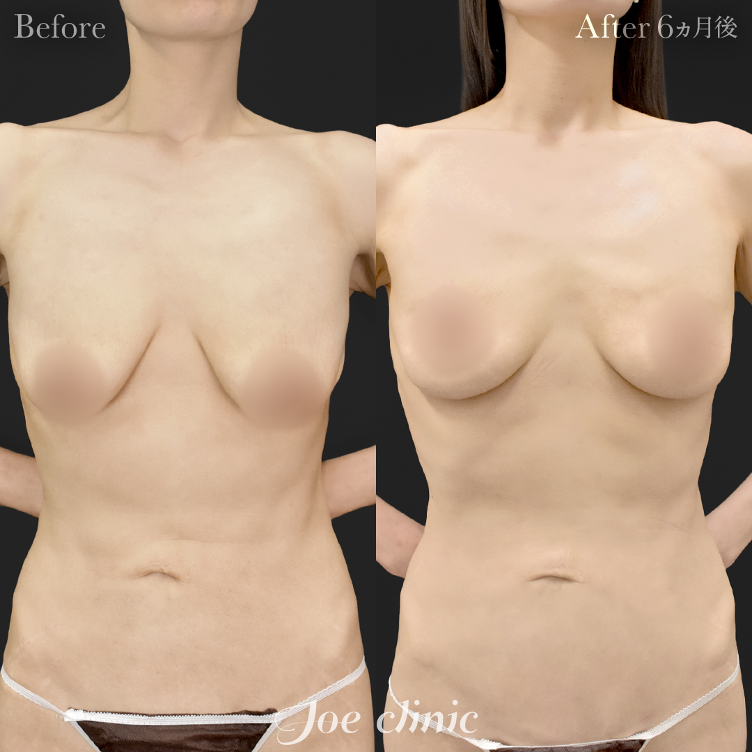 【30代女性】乳房吊り上げ術＋脂肪幹細胞注入豊胸（100cc×左右）｜6ヵ月後