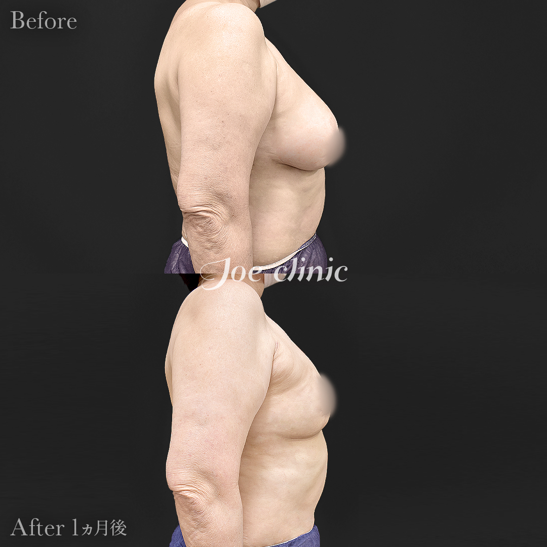 【60代女性】乳房縮小術＋脂肪吸引（胸部）｜1ヵ月後