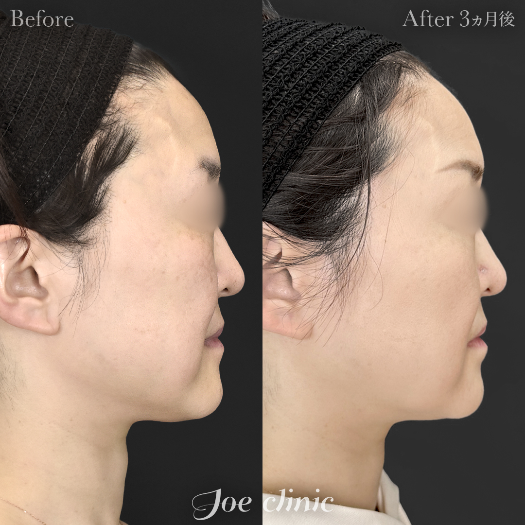 【40代女性】糸リフト（3Dスパイラルリフト）＋ボトックス注射｜3ヵ月後