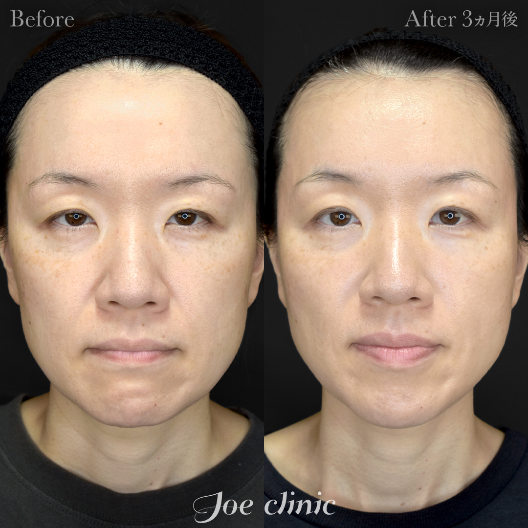 【40代女性】糸リフト（3Dスパイラルリフト）＋ヒアルロン酸注入（鼻翼基部）｜3ヵ月後
