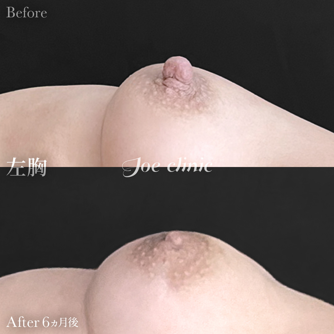 【40代女性】乳頭縮小術｜6ヵ月後