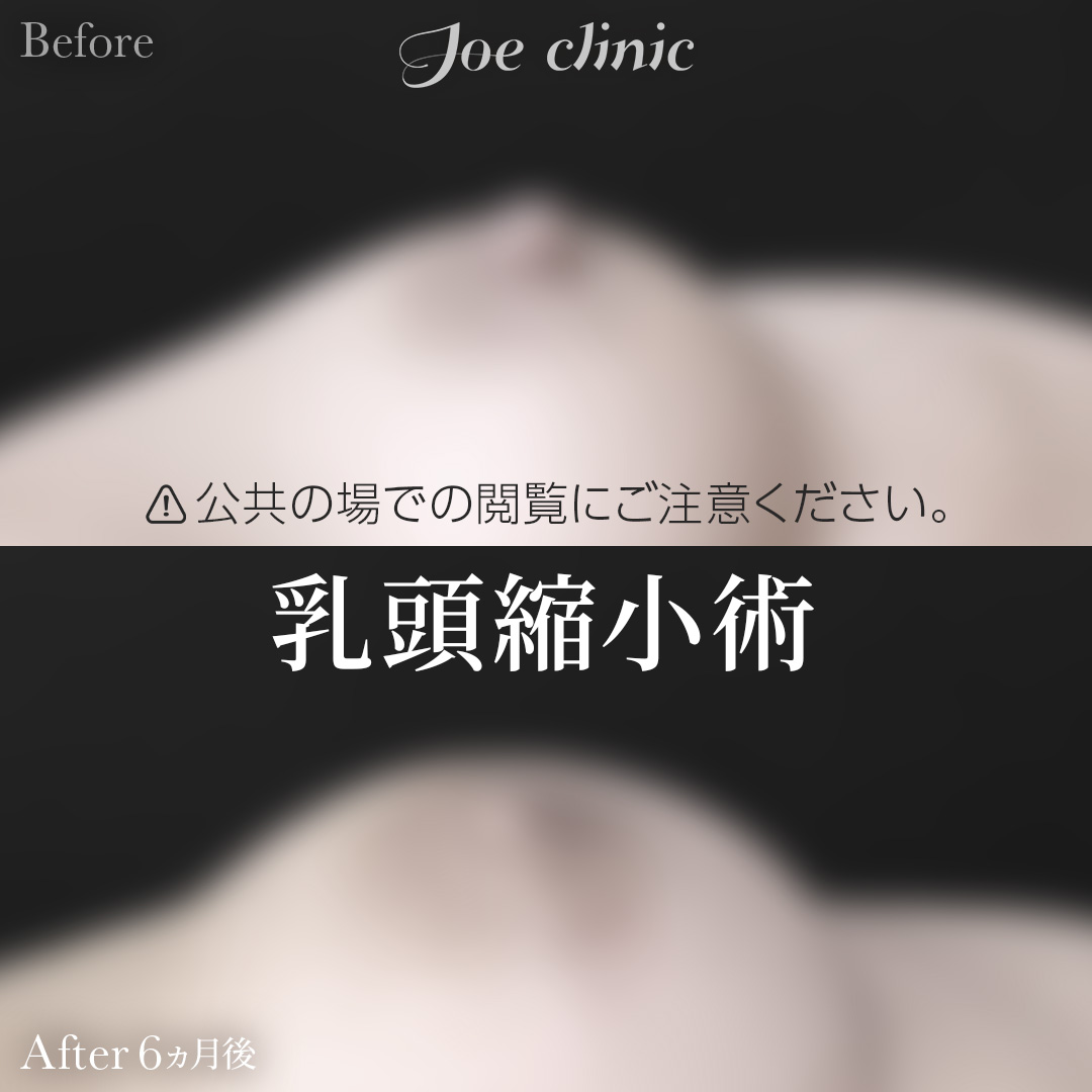 【40代女性】乳頭縮小術｜6ヵ月後