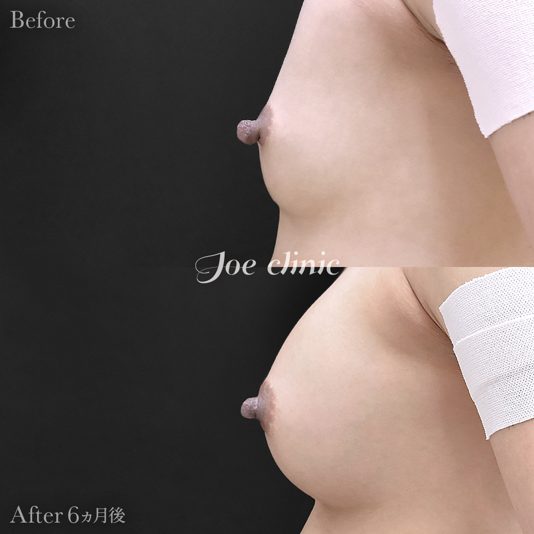 【20代女性】乳頭縮小術｜6ヵ月後