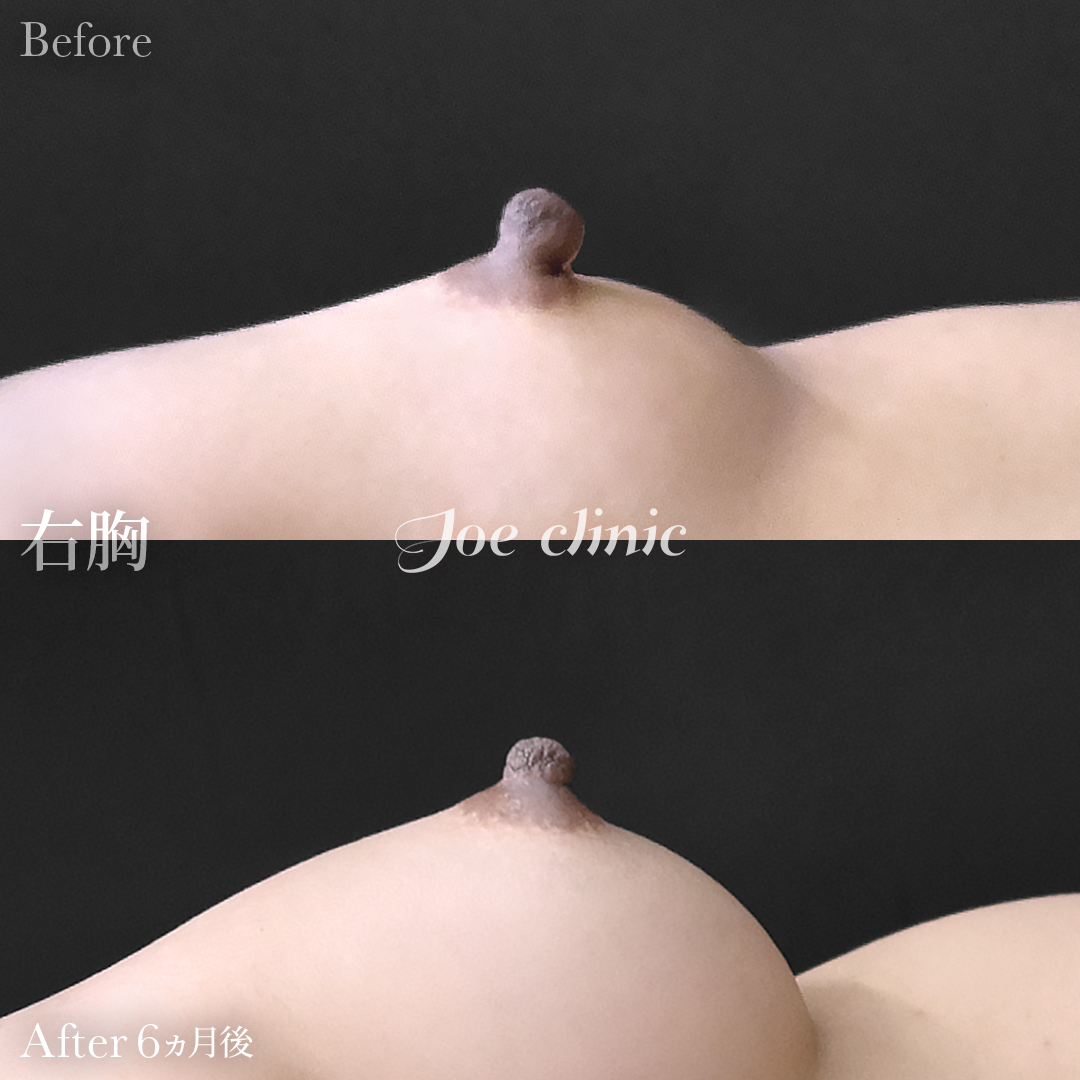【20代女性】乳頭縮小術｜6ヵ月後