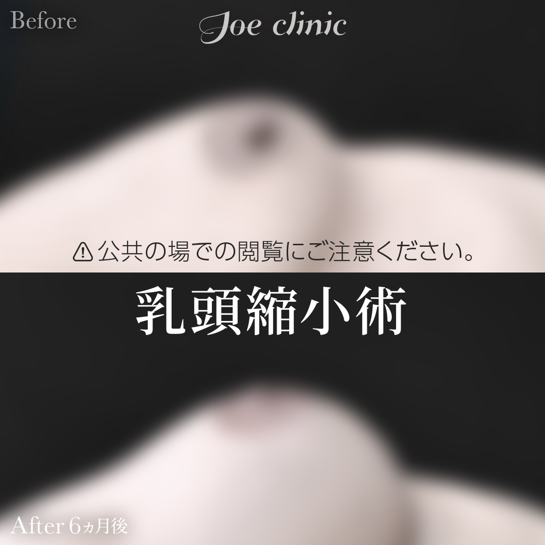 【20代女性】乳頭縮小術｜6ヵ月後