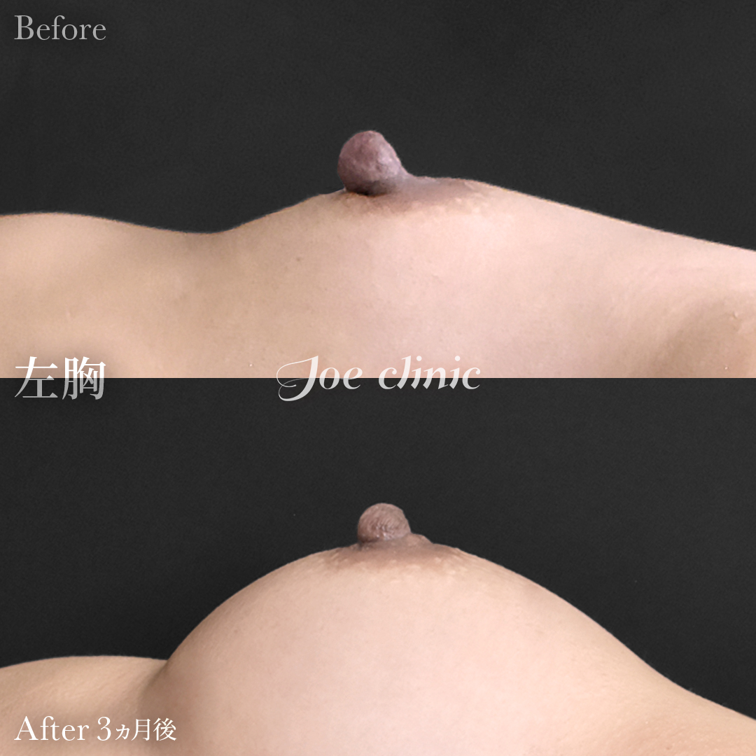 【30代女性】乳頭縮小術｜3ヵ月後