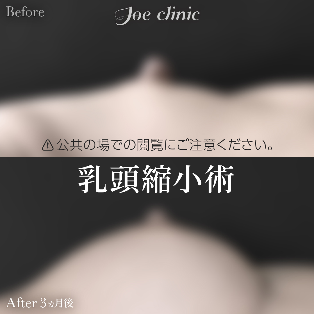【30代女性】乳頭縮小術｜3ヵ月後