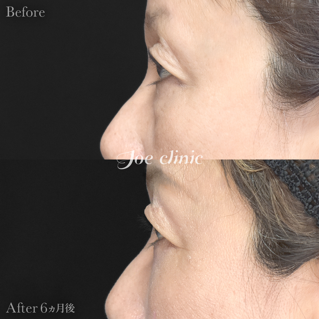 【60代女性】目の下のクマ取り(ハムラ法)|6ヵ月後