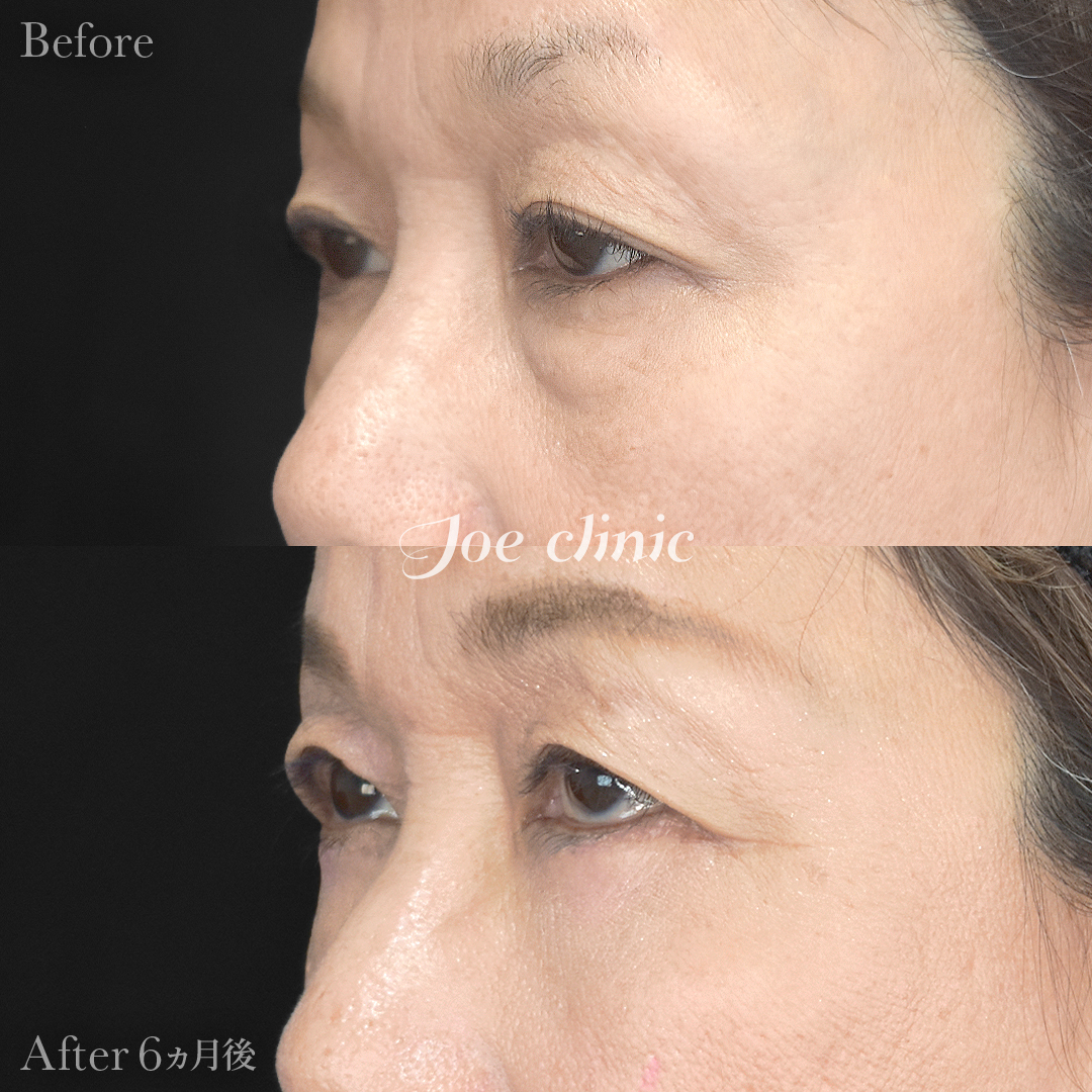 【60代女性】目の下のクマ取り(ハムラ法)|6ヵ月後