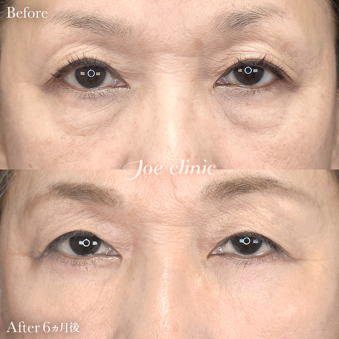 【60代女性】目の下のクマ取り(ハムラ法)|6ヵ月後