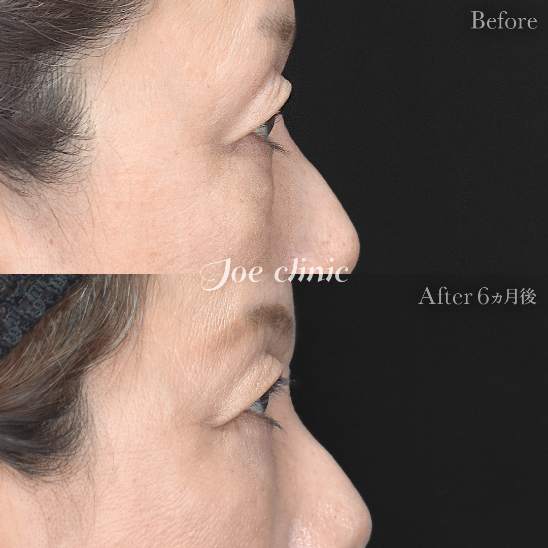 【60代女性】目の下のクマ取り(ハムラ法)|6ヵ月後