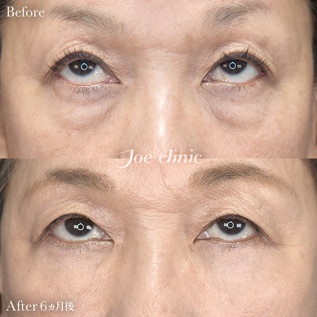 【60代女性】目の下のクマ取り(ハムラ法)|6ヵ月後