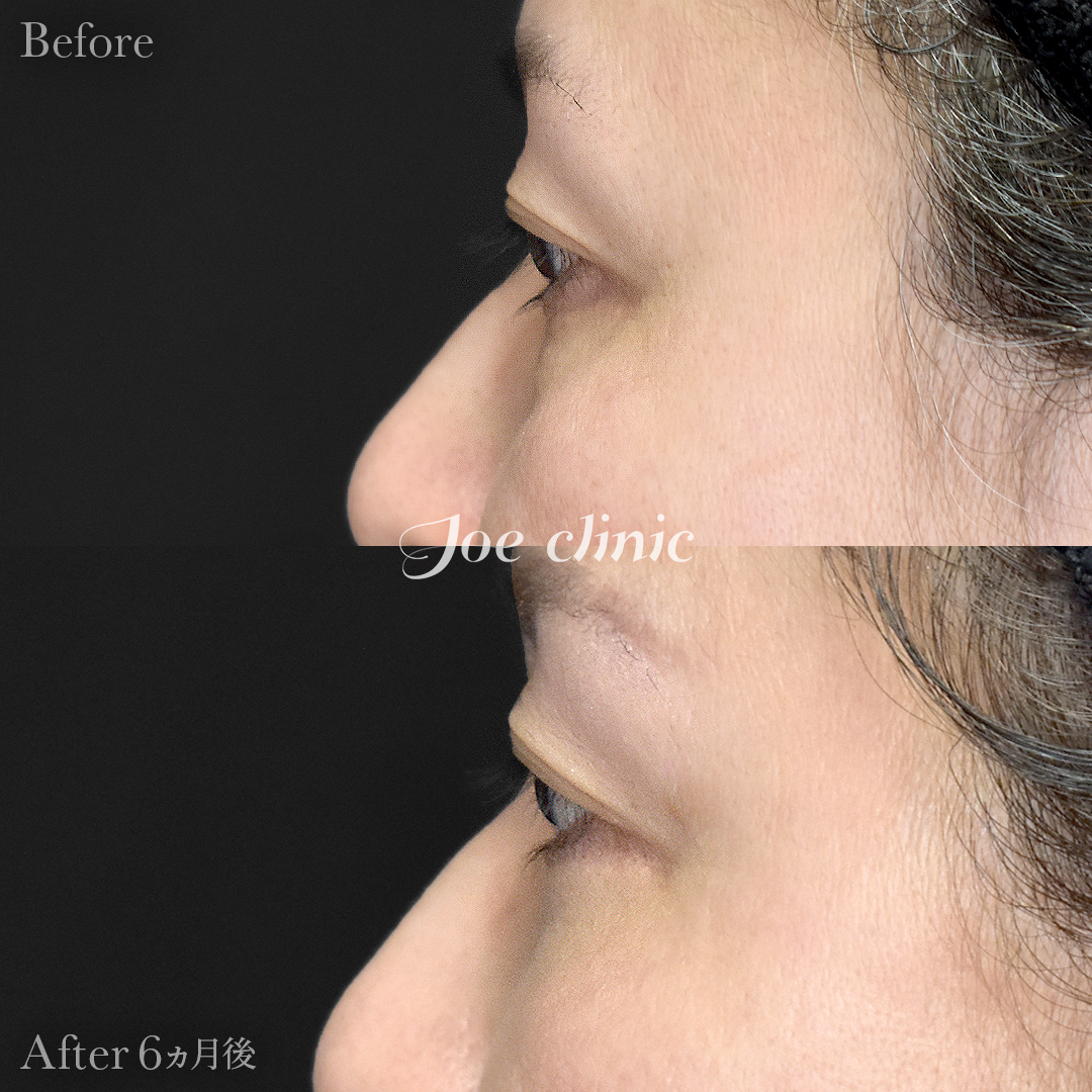 【40代女性】目の下のクマ取り(ハムラ法)|6ヵ月後