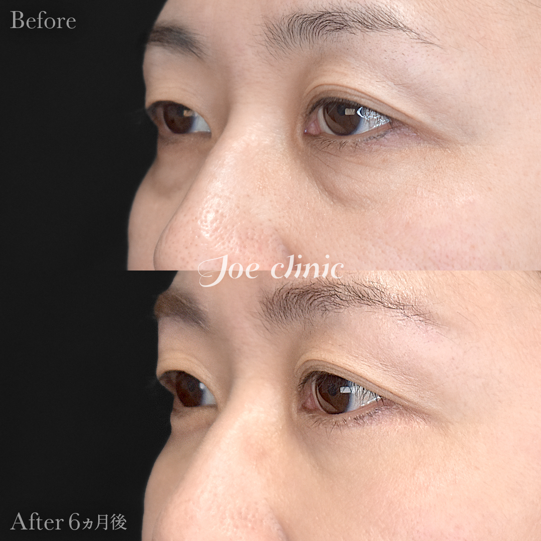 【40代女性】目の下のクマ取り(ハムラ法)|6ヵ月後