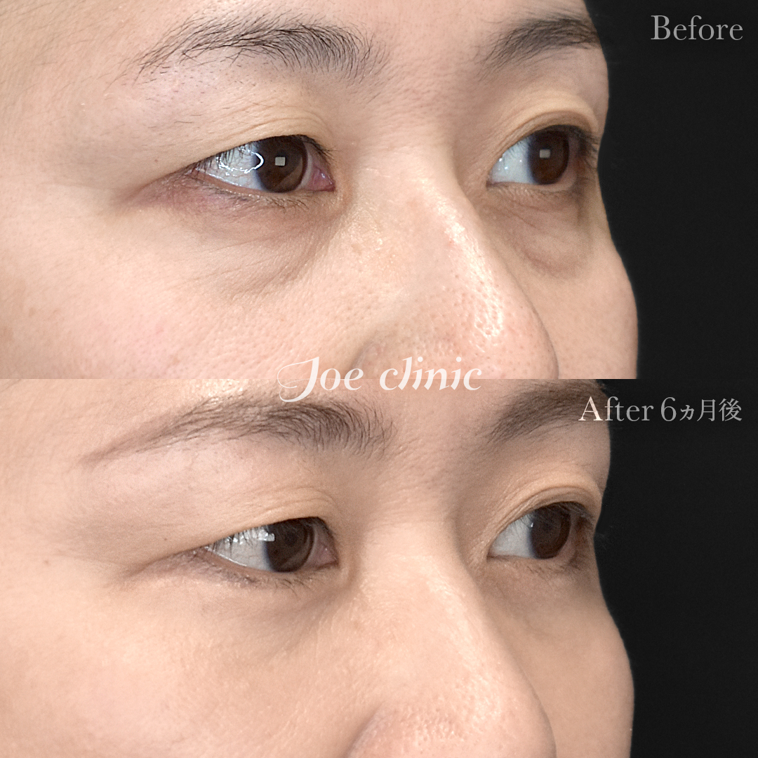 【40代女性】目の下のクマ取り(ハムラ法)|6ヵ月後