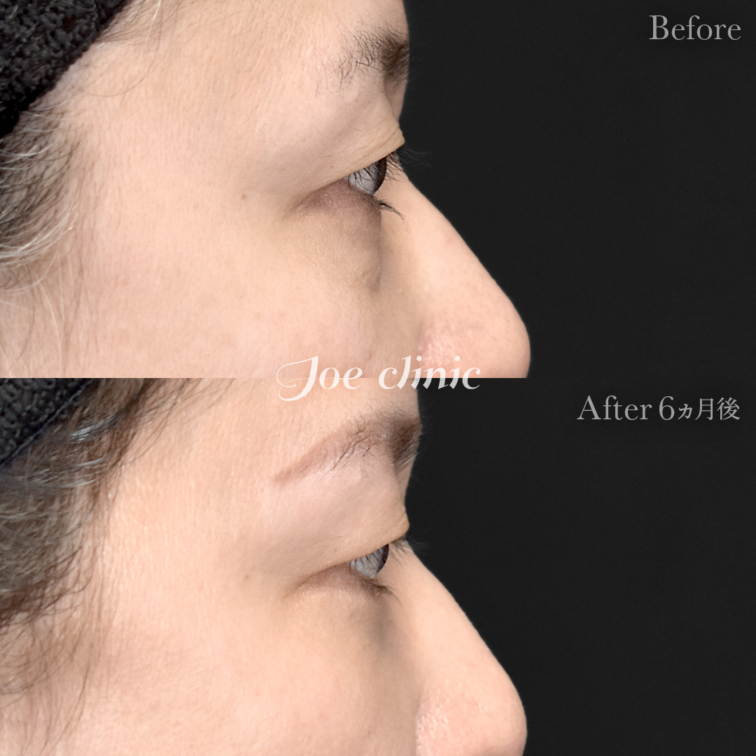 【40代女性】目の下のクマ取り(ハムラ法)|6ヵ月後