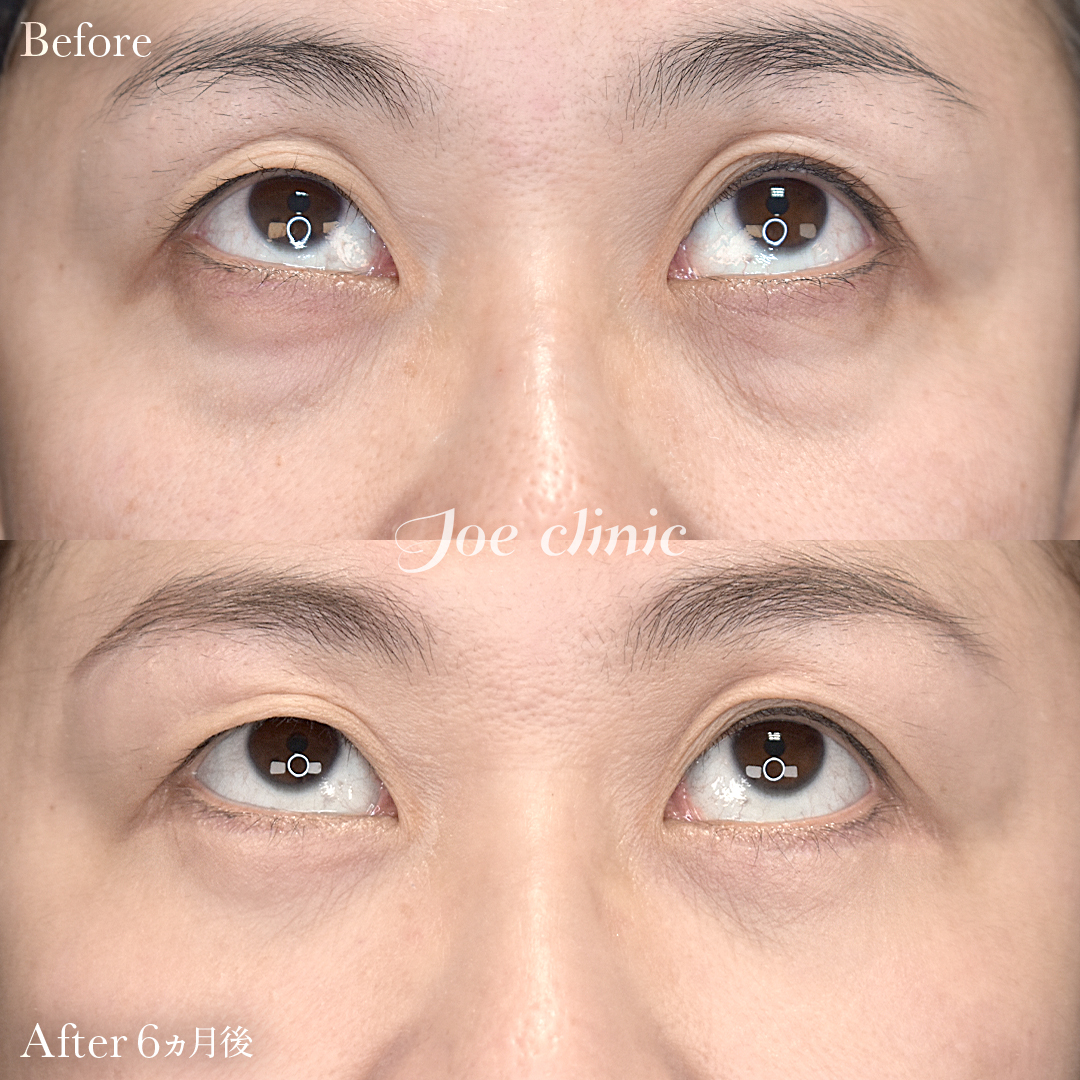 【40代女性】目の下のクマ取り(ハムラ法)|6ヵ月後