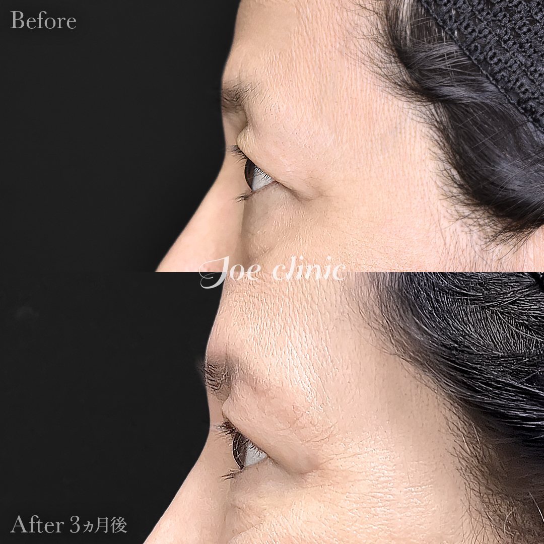 【60代女性】眉下リフト（眉下切開）｜3ヵ月後