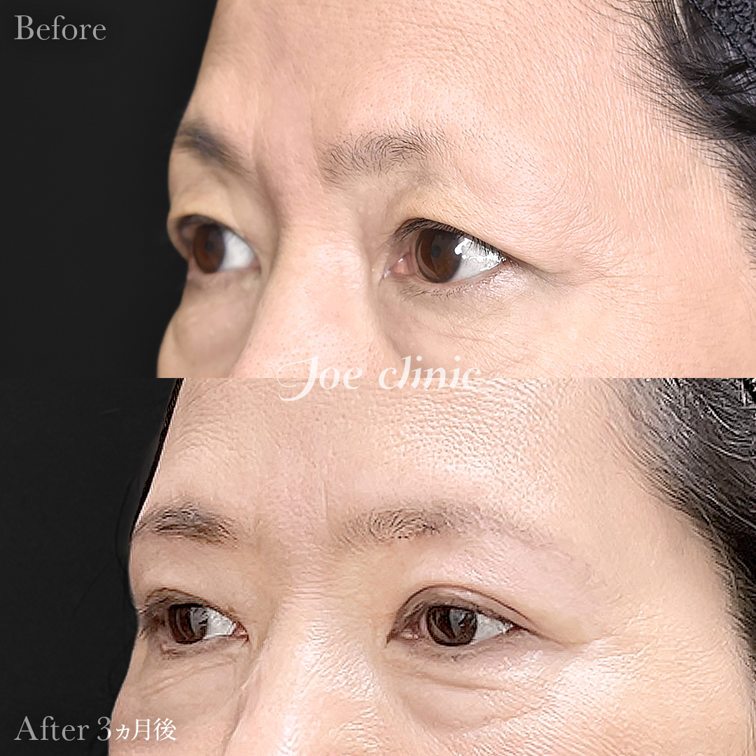 【60代女性】眉下リフト（眉下切開）｜3ヵ月後