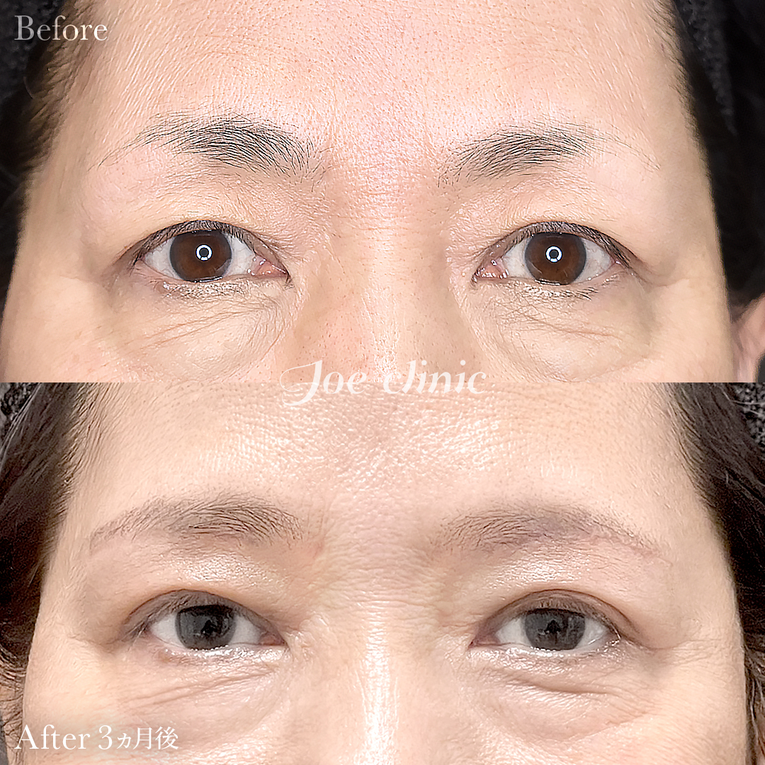 【60代女性】眉下リフト（眉下切開）｜3ヵ月後