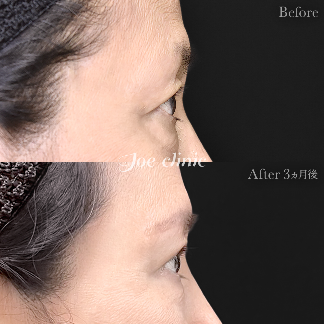 【60代女性】眉下リフト（眉下切開）｜3ヵ月後