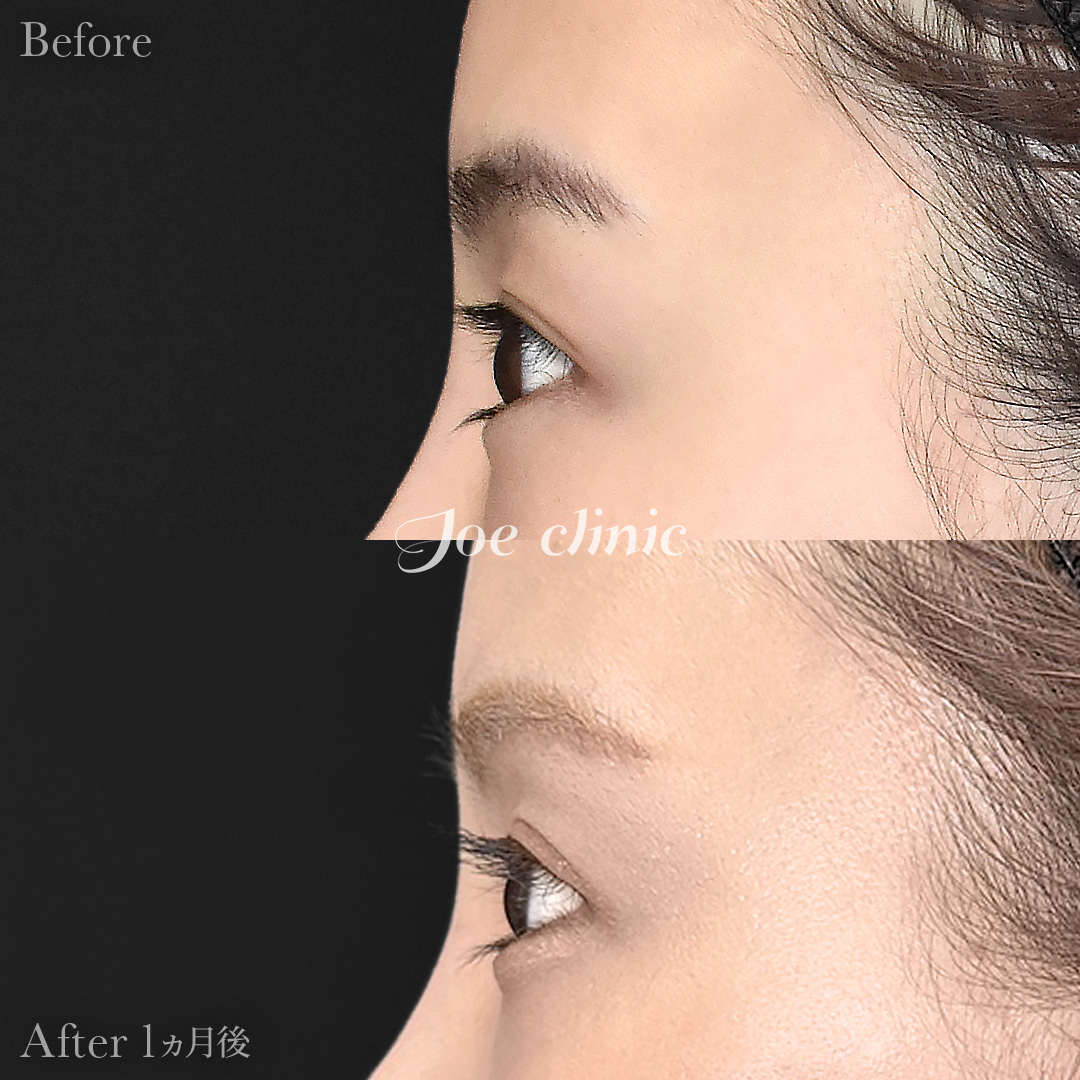 【30代女性】眉下リフト（眉下切開）｜1ヵ月後