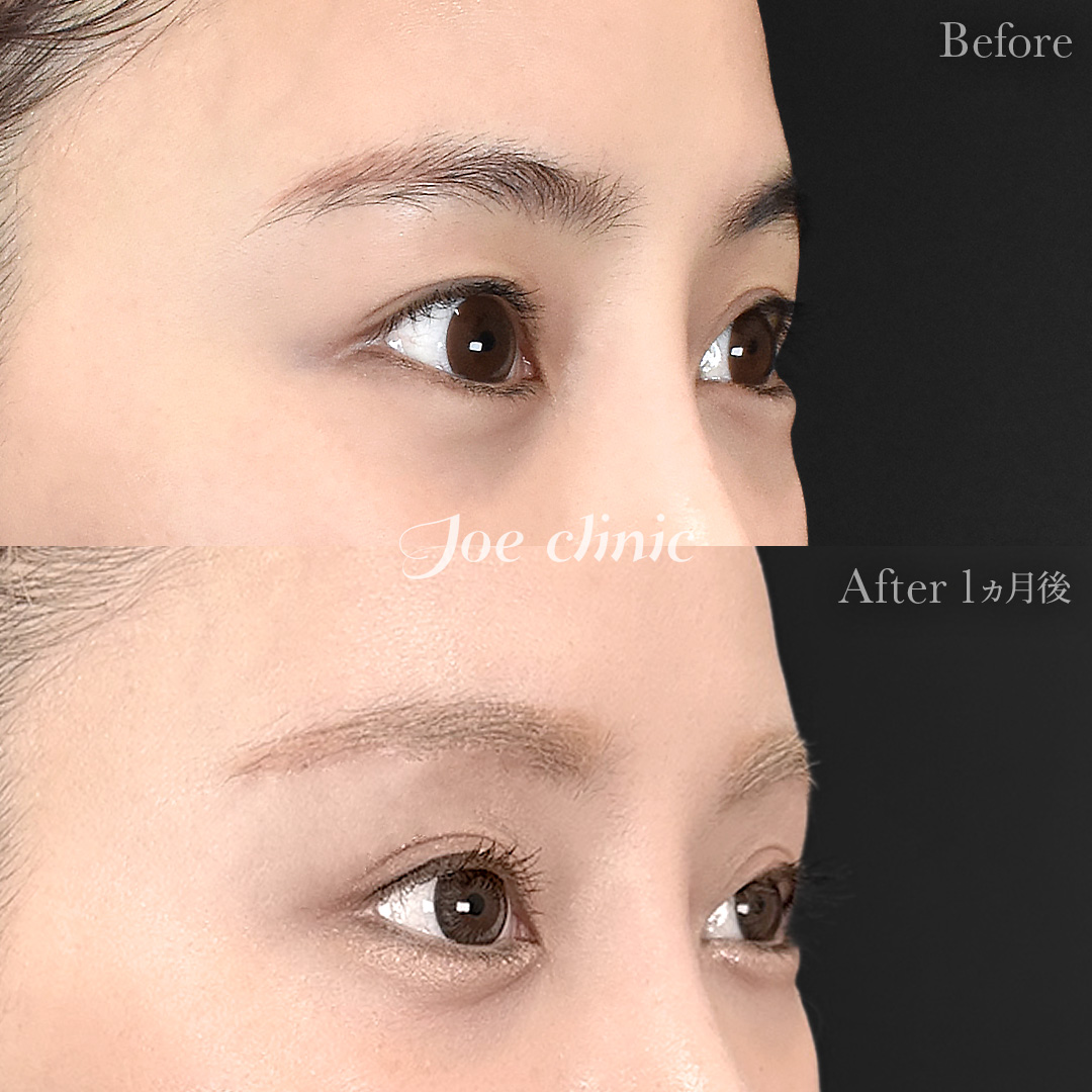 【30代女性】眉下リフト（眉下切開）｜1ヵ月後