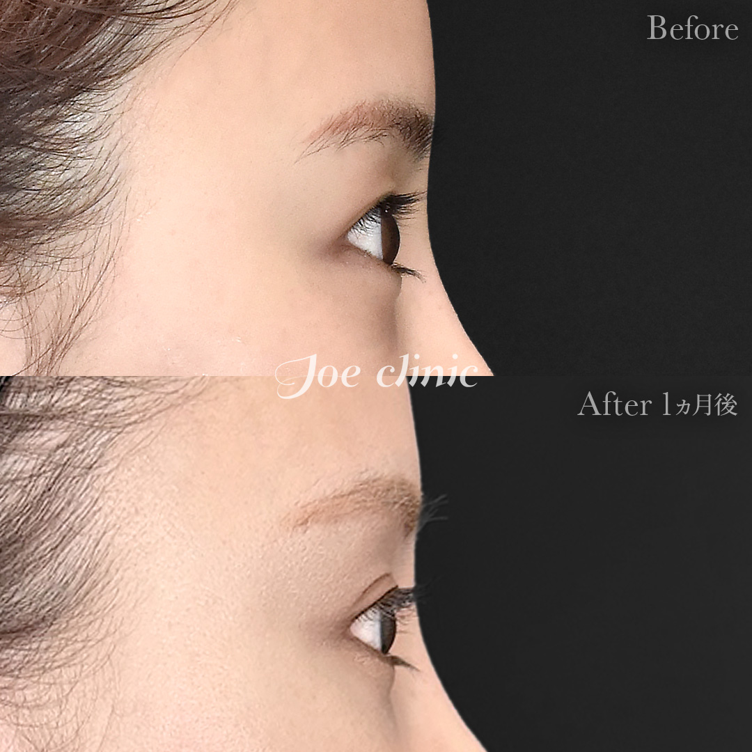 【30代女性】眉下リフト（眉下切開）｜1ヵ月後