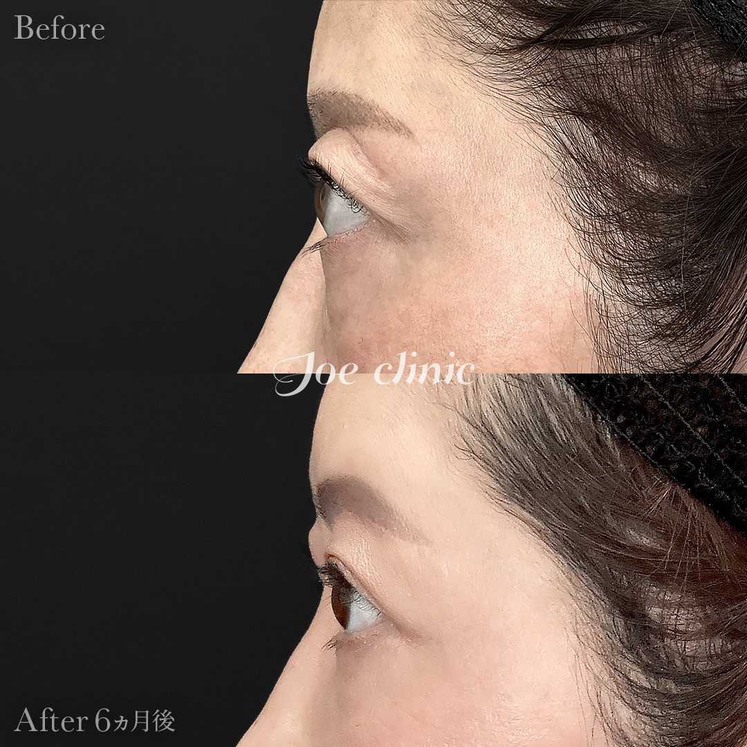 【40代女性】目の下のクマ取り(たるみ取り術)+眉下リフト(眉下切開)|6ヵ月後