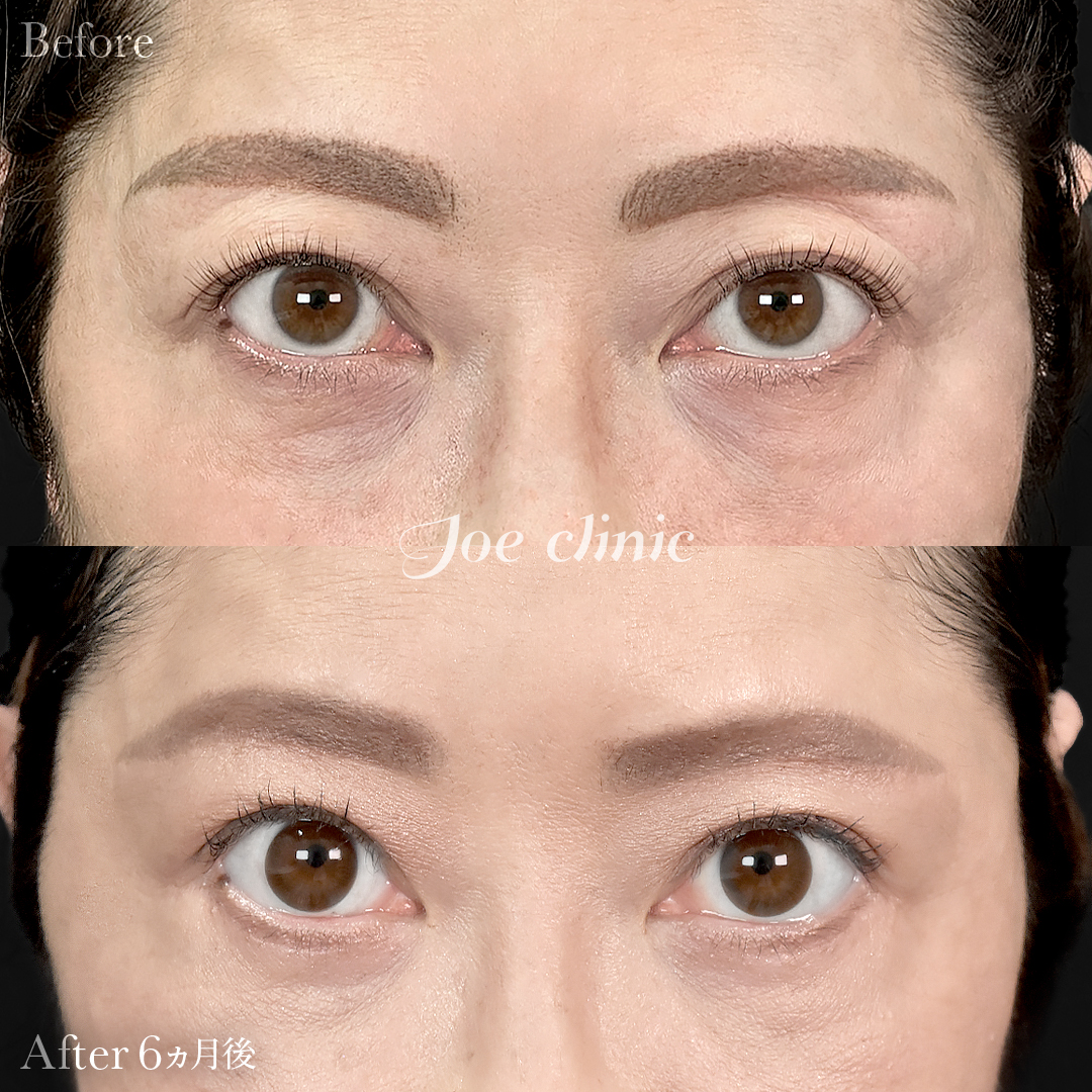 【40代女性】目の下のクマ取り(たるみ取り術)+眉下リフト(眉下切開)|6ヵ月後