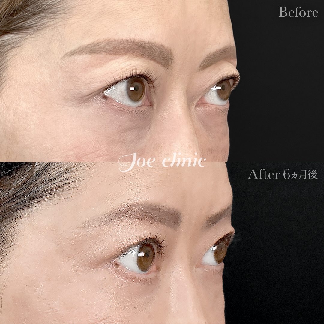 【40代女性】目の下のクマ取り(たるみ取り術)+眉下リフト(眉下切開)|6ヵ月後