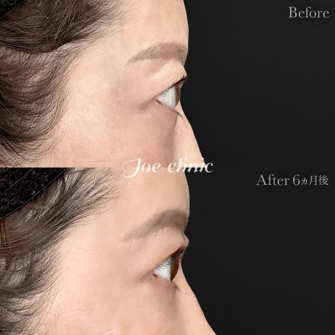 【40代女性】目の下のクマ取り(たるみ取り術)+眉下リフト(眉下切開)|6ヵ月後