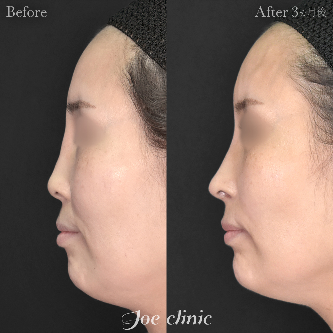 【40代女性・他院修正】他院アクアミド除去＋鼻フルコース［クローズ法］（鼻複合自家組織移植術）＋筋膜移植｜3ヵ月後