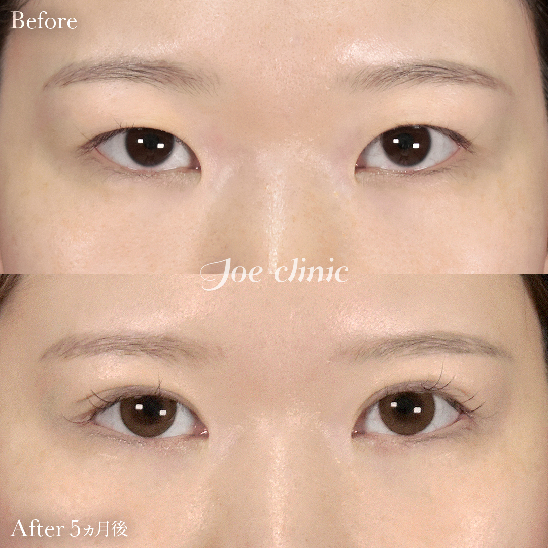 【20代女性】目フルコース|5ヵ月後