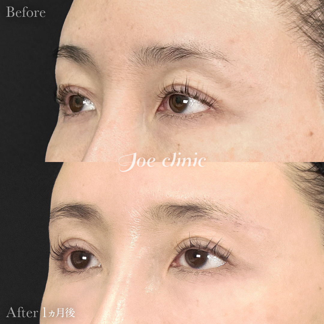 【40代女性】眉下リフト(眉下切開)|1ヵ月後