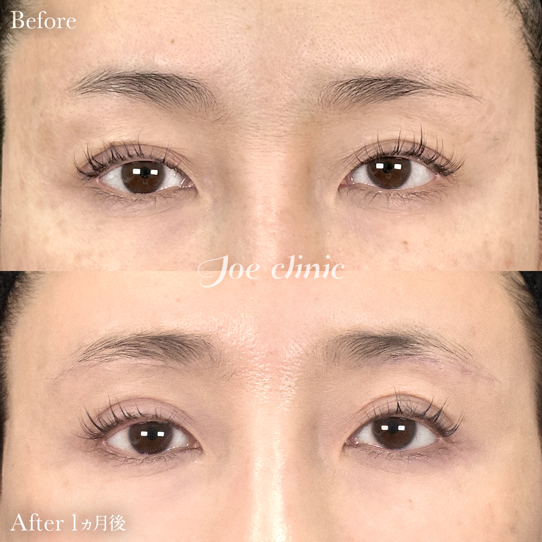 【40代女性】眉下リフト(眉下切開)|1ヵ月後