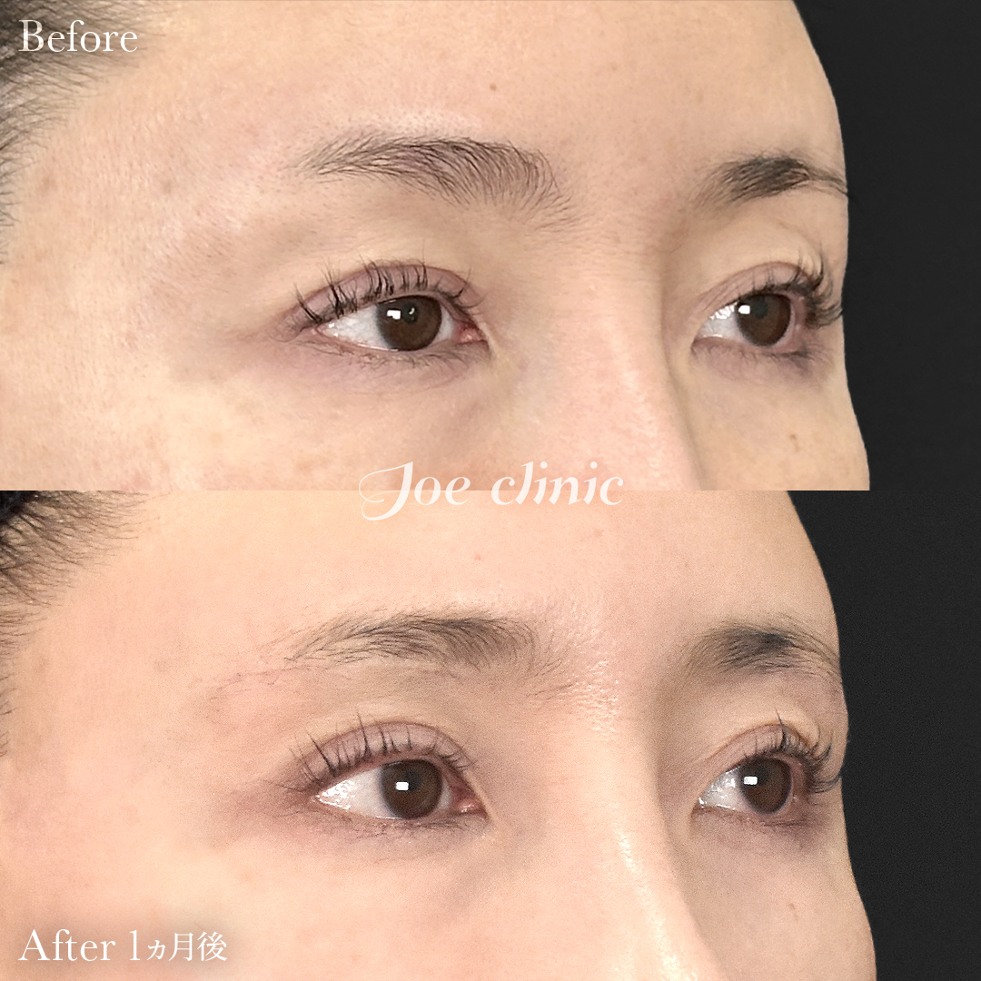 【40代女性】眉下リフト(眉下切開)|1ヵ月後