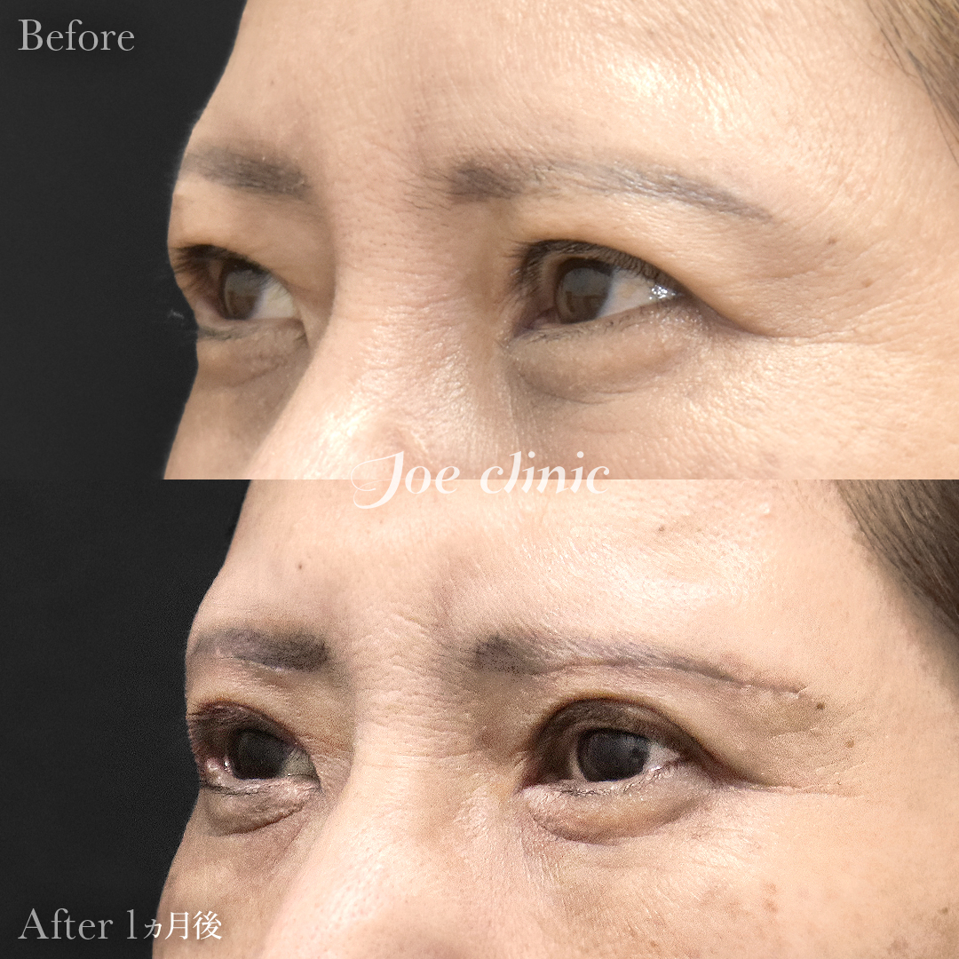 【50代女性】眉下リフト(眉下切開)|1ヵ月後