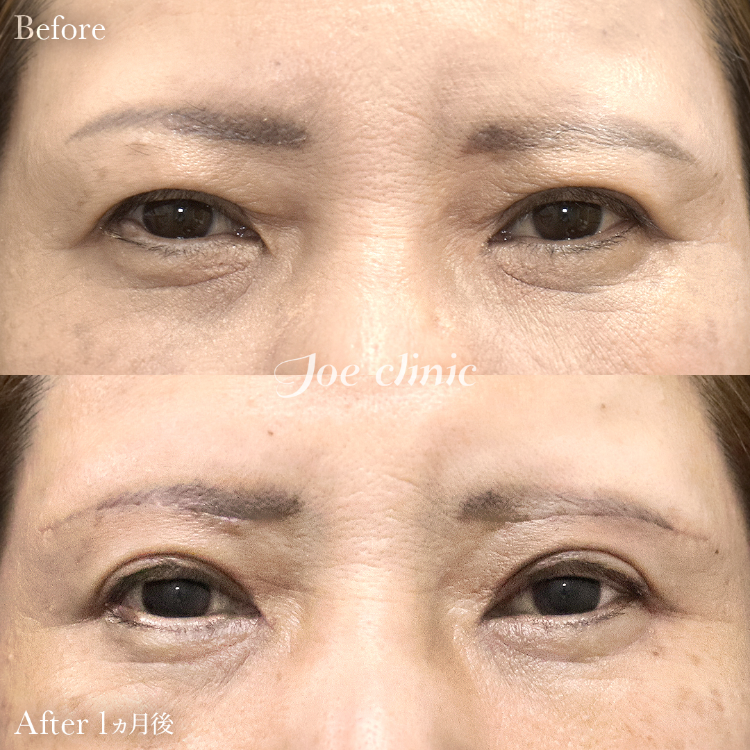 【50代女性】眉下リフト(眉下切開)|1ヵ月後