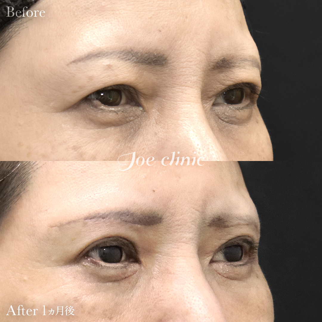 【50代女性】眉下リフト(眉下切開)|1ヵ月後