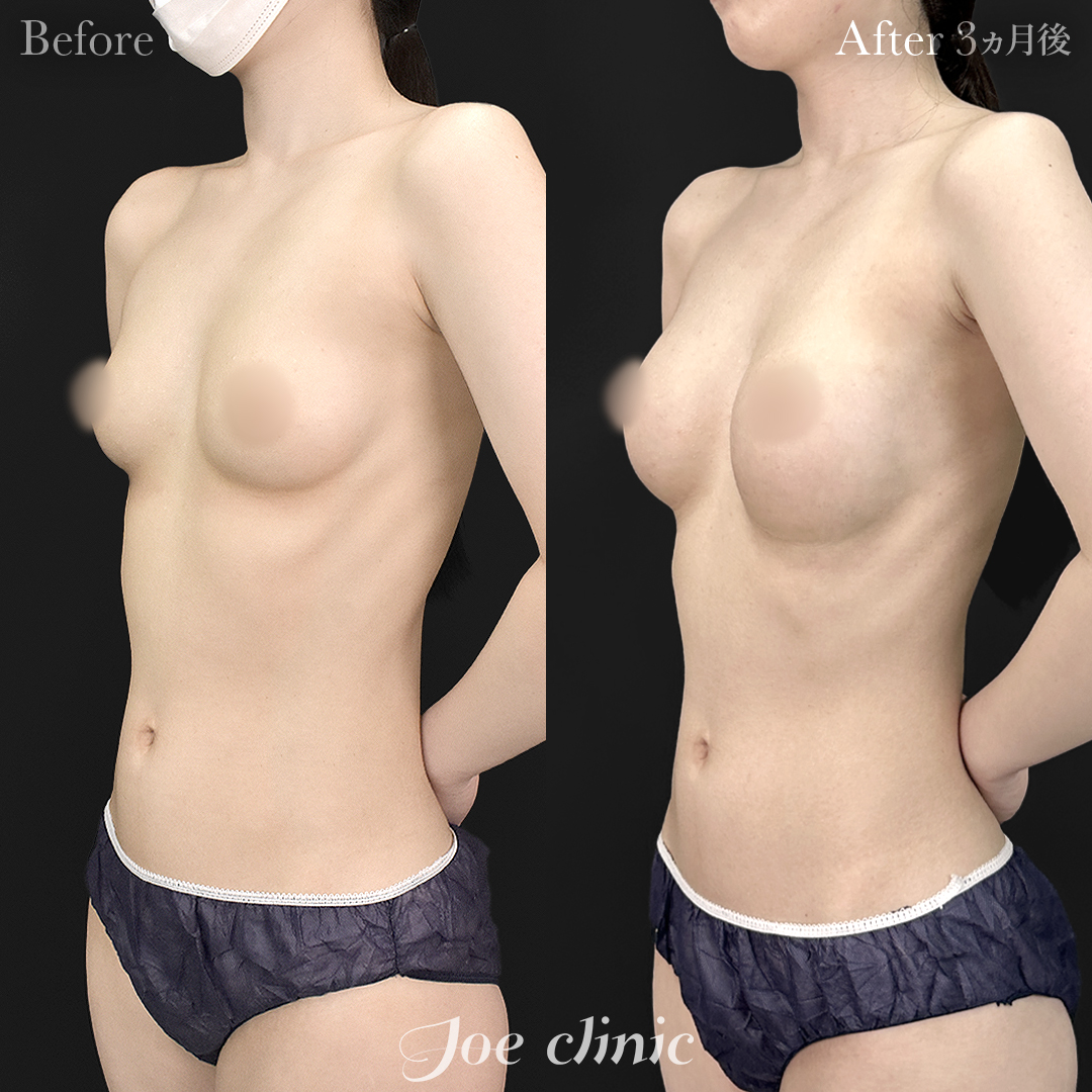 【20代女性】シリコンバッグ豊胸モティバ2(260cc×左右)|3ヵ月後