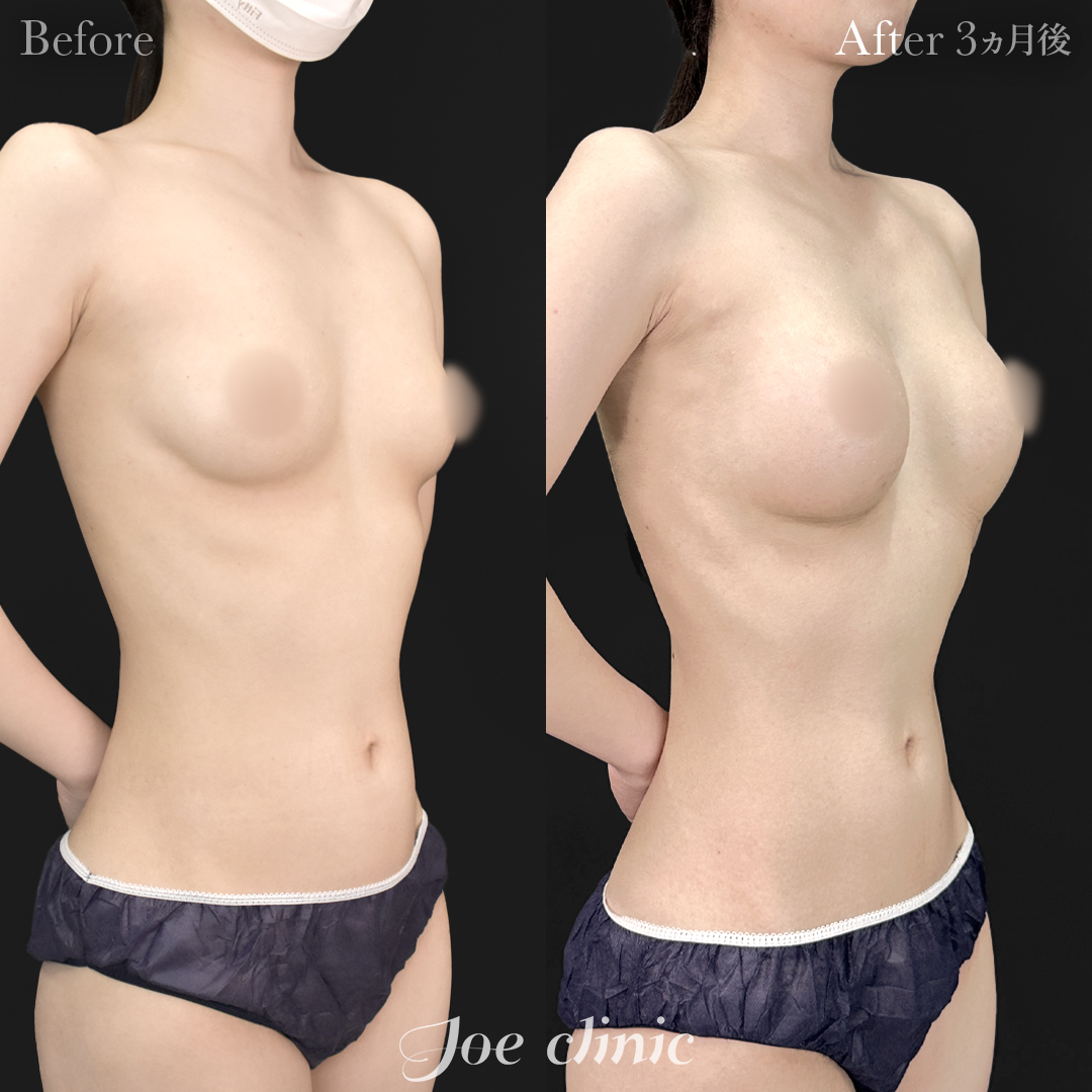 【20代女性】シリコンバッグ豊胸モティバ2（260cc×左右）｜3ヵ月後