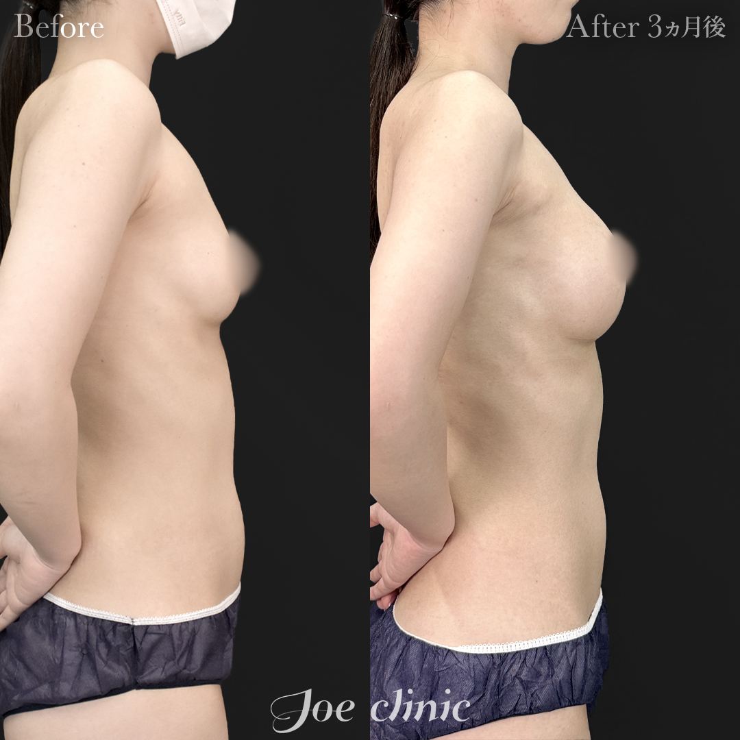 【20代女性】シリコンバッグ豊胸モティバ2(260cc×左右)|3ヵ月後